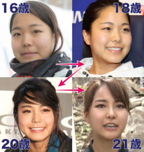 沙羅 整形 🐝高梨 高梨沙羅の顔の変化を時系列でまとめてみた！昔と現在の顔を画像で比較！